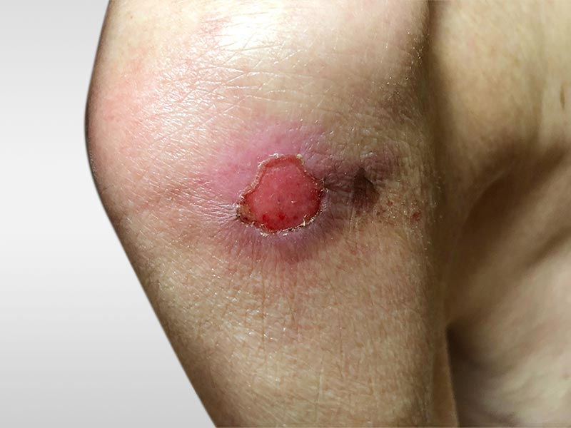 Pressure Ulcers prevention in elderly patients